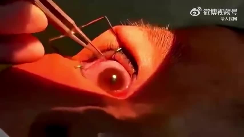Video-Hot - Bác sĩ gắp ra hơn 60 con giun ký sinh trong mắt người phụ nữ (Hình 2).